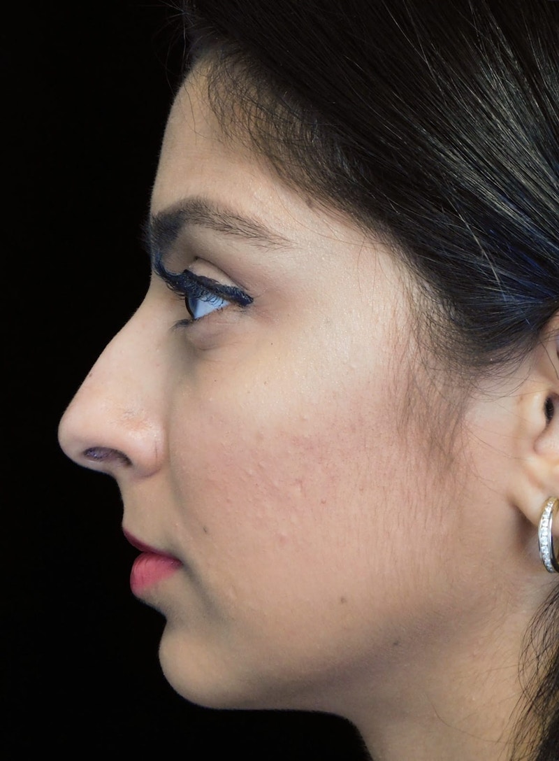 Beverly Hills Left Side View Rhinoplasty Before in Beverly Hills by Dr. Deepak Raj Dugar | Patient 165430 Dr. Deepak Raj Dugar