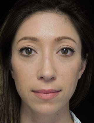 Beverly Hills Front View Rhinoplasty After in Beverly Hills by Dr. Deepak Raj Dugar | Patient 264373 Dr. Deepak Raj Dugar