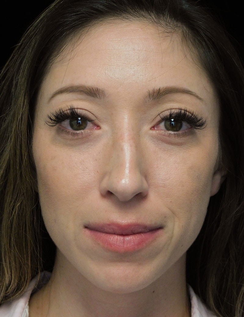 Beverly Hills Front View Rhinoplasty Before in Beverly Hills by Dr. Deepak Raj Dugar | Patient 264373 Dr. Deepak Raj Dugar