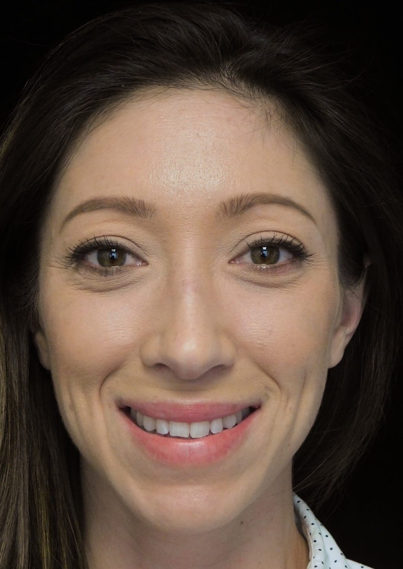 Beverly Hills Front Smile View Rhinoplasty After in Beverly Hills by Dr. Deepak Raj Dugar | Patient 264373 Dr. Deepak Raj Dugar