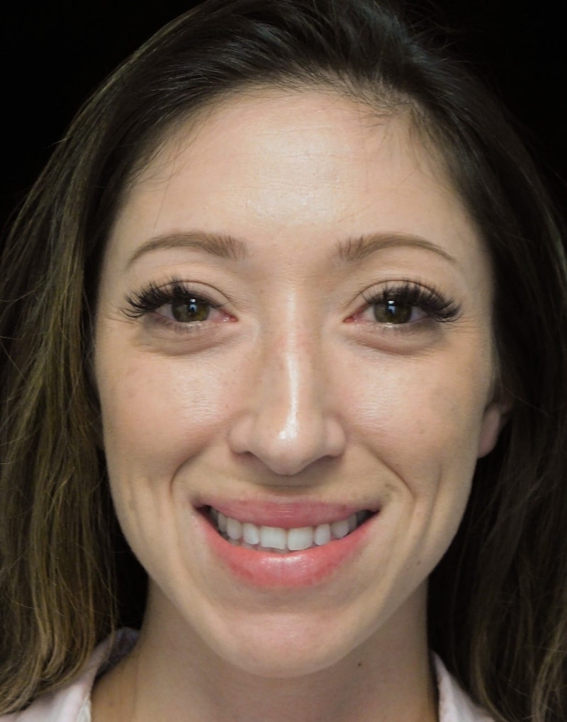 Beverly Hills Front Smile View Rhinoplasty Before in Beverly Hills by Dr. Deepak Raj Dugar | Patient 264373 Dr. Deepak Raj Dugar
