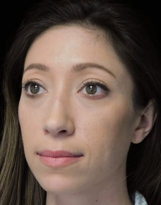 Beverly Hills ObliqueView Rhinoplasty After in Beverly Hills by Dr. Deepak Raj Dugar | Patient 264373 Dr. Deepak Raj Dugar