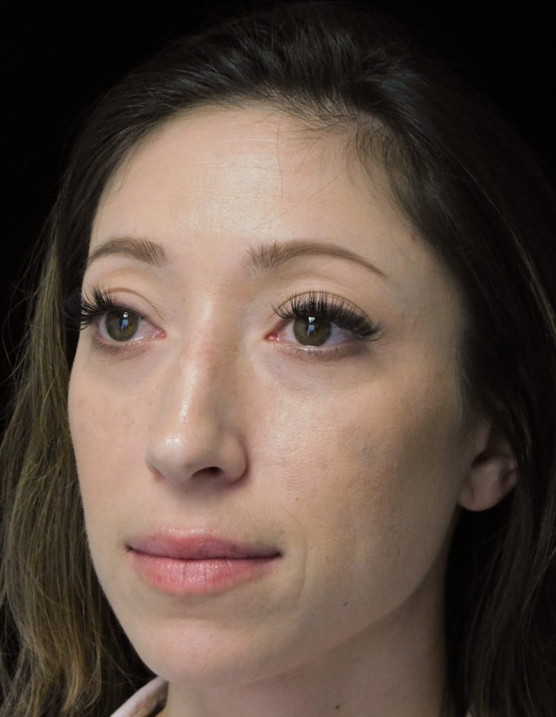 Beverly Hills ObliqueView Rhinoplasty Before in Beverly Hills by Dr. Deepak Raj Dugar | Patient 264373 Dr. Deepak Raj Dugar