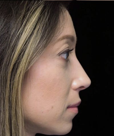 Beverly Hills Right Side View Rhinoplasty After in Beverly Hills by Dr. Deepak Raj Dugar | Patient 264373 Dr. Deepak Raj Dugar