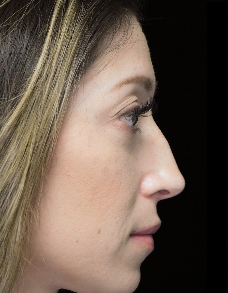 Beverly Hills Right Side View Rhinoplasty Before in Beverly Hills by Dr. Deepak Raj Dugar | Patient 264373 Dr. Deepak Raj Dugar