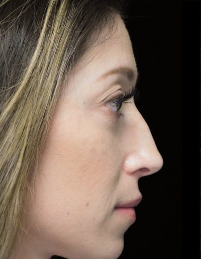 Beverly Hills Right Side View Rhinoplasty Before in Beverly Hills by Dr. Deepak Raj Dugar | Patient 264373 Dr. Deepak Raj Dugar