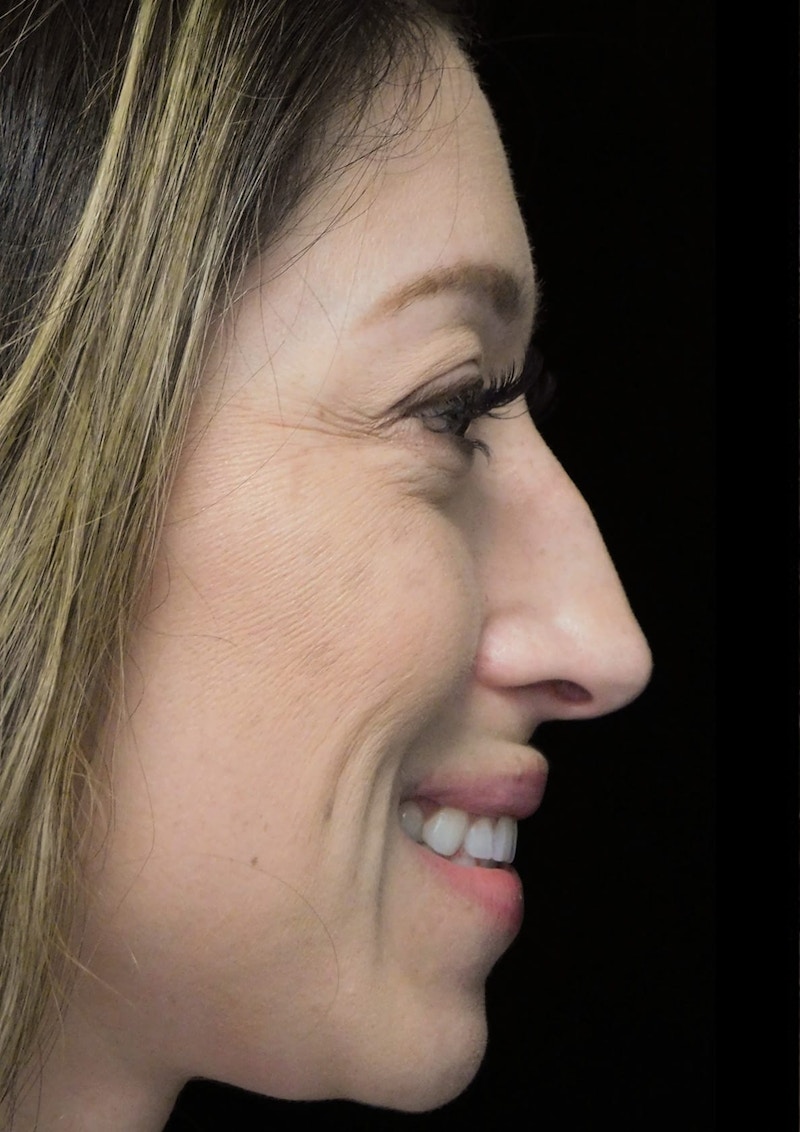 Beverly Hills Right Smile View Rhinoplasty Before in Beverly Hills by Dr. Deepak Raj Dugar | Patient 264373 Dr. Deepak Raj Dugar