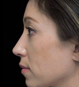 Beverly Hills Left View Rhinoplasty After in Beverly Hills by Dr. Deepak Raj Dugar | Patient 264373 Dr. Deepak Raj Dugar