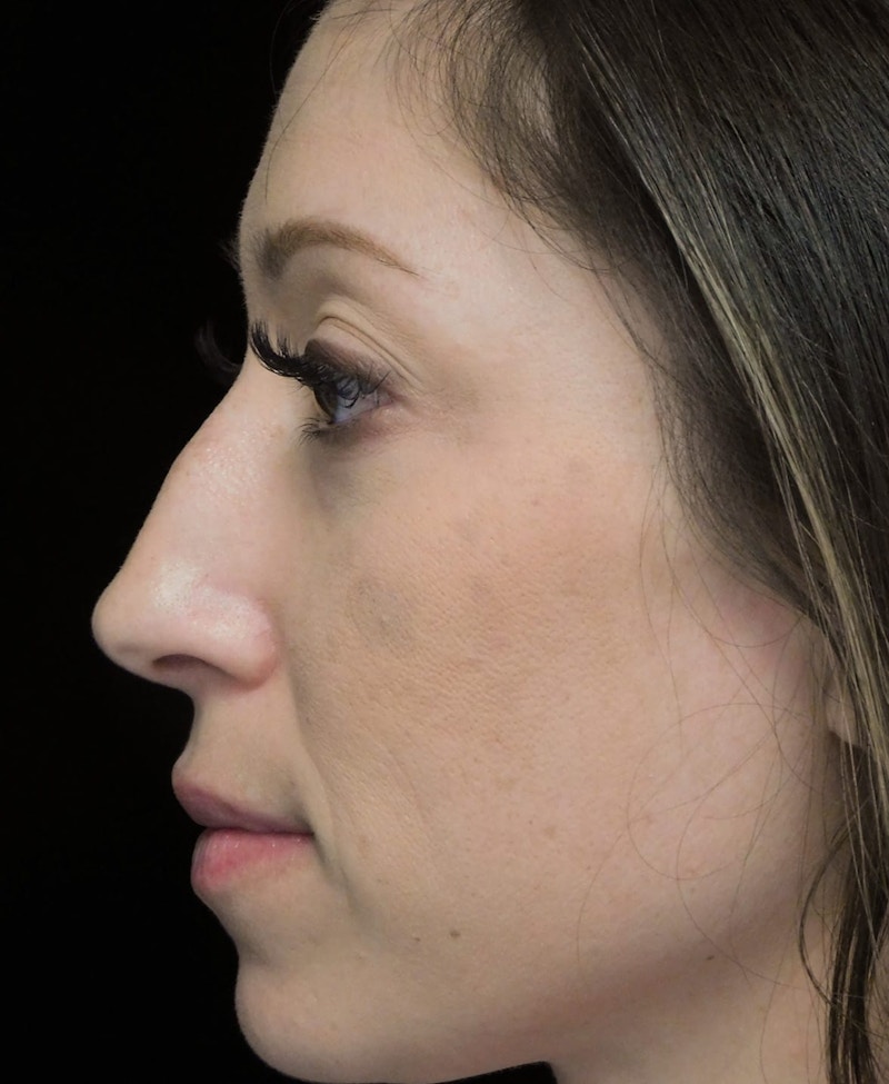 Beverly Hills Left View Rhinoplasty Before in Beverly Hills by Dr. Deepak Raj Dugar | Patient 264373 Dr. Deepak Raj Dugar