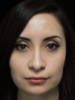 Beverly Hills Front View Rhinoplasty After in Beverly Hills by Dr. Deepak Raj Dugar | Patient 292548 Dr. Deepak Raj Dugar