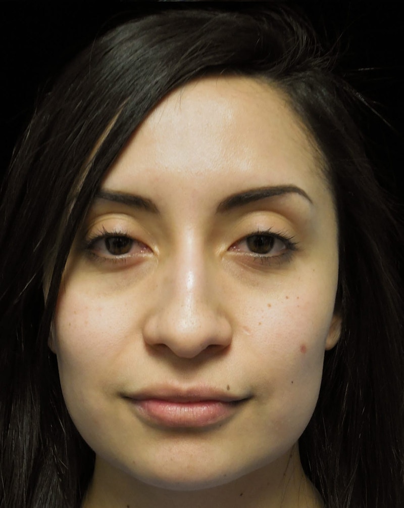 Beverly Hills Front View Rhinoplasty Before in Beverly Hills by Dr. Deepak Raj Dugar | Patient 292548 Dr. Deepak Raj Dugar