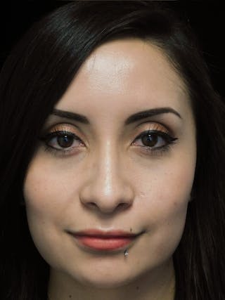 Beverly Hills Front Smile View Rhinoplasty After in Beverly Hills by Dr. Deepak Raj Dugar | Patient 292548 Dr. Deepak Raj Dugar