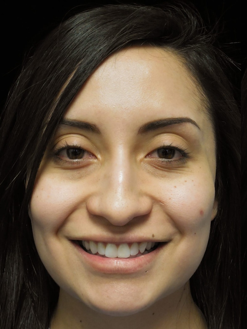 Beverly Hills Front Smile View Rhinoplasty Before in Beverly Hills by Dr. Deepak Raj Dugar | Patient 292548 Dr. Deepak Raj Dugar