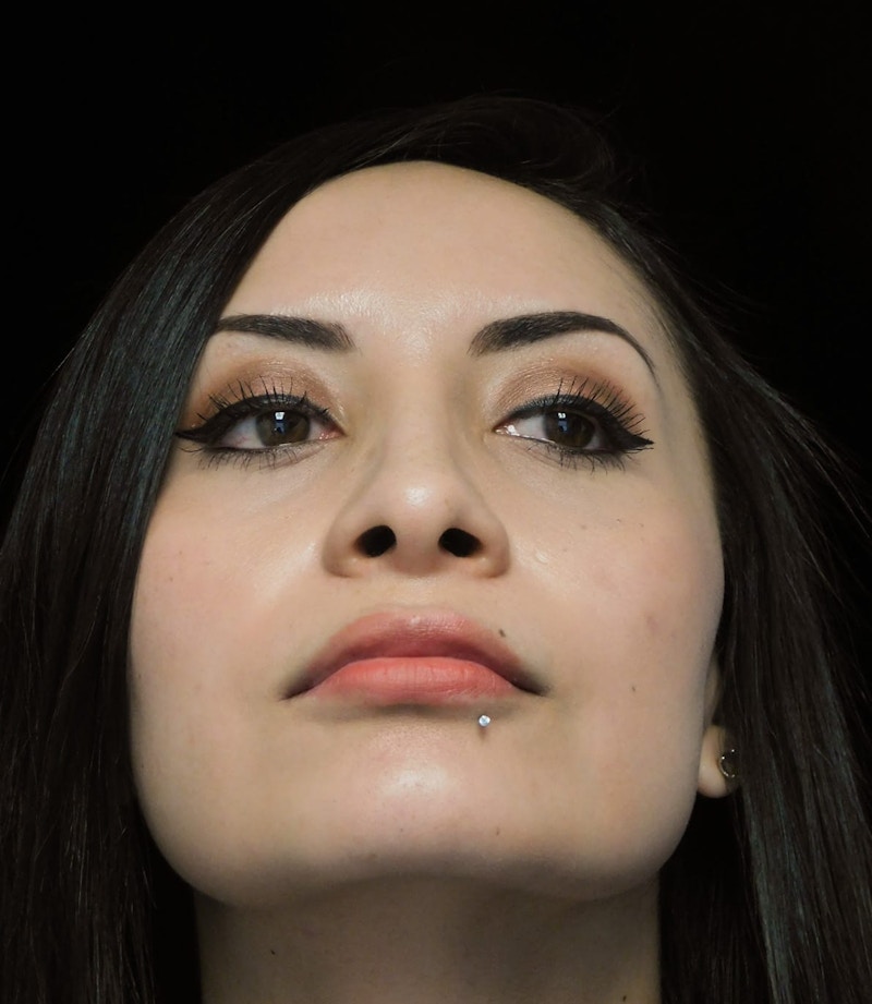 Beverly Hills Under View Rhinoplasty After in Beverly Hills by Dr. Deepak Raj Dugar | Patient 292548 Dr. Deepak Raj Dugar