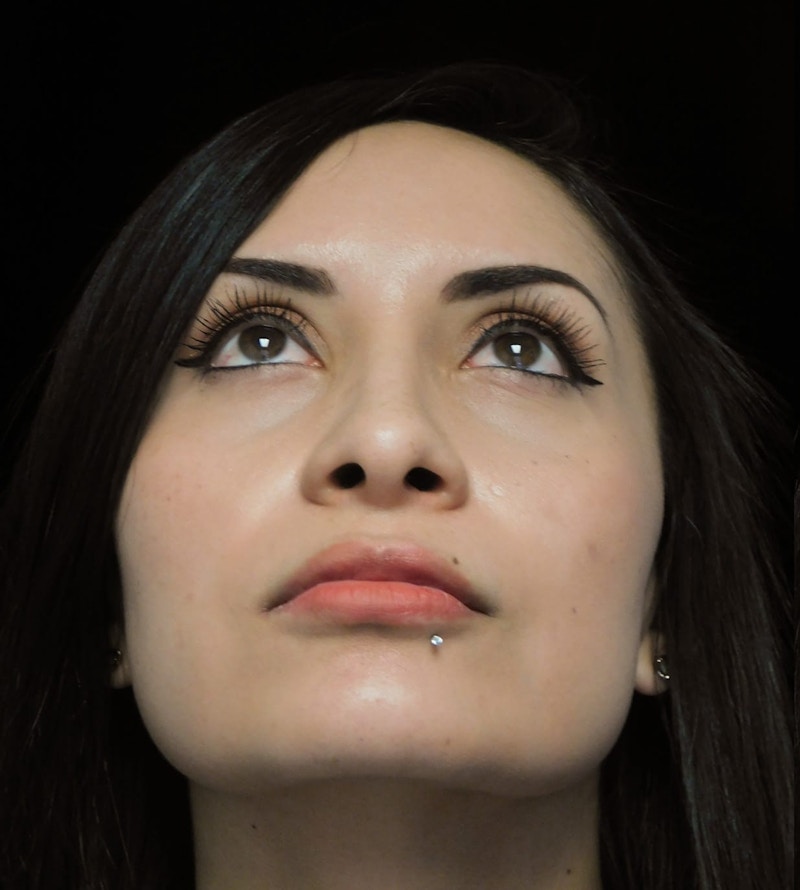 Beverly Hills Under View Rhinoplasty Before in Beverly Hills by Dr. Deepak Raj Dugar | Patient 292548 Dr. Deepak Raj Dugar