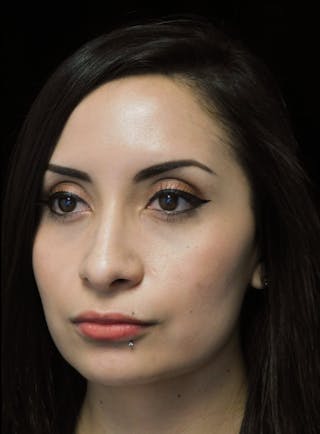 Beverly Hills Oblique View Rhinoplasty After in Beverly Hills by Dr. Deepak Raj Dugar | Patient 292548 Dr. Deepak Raj Dugar