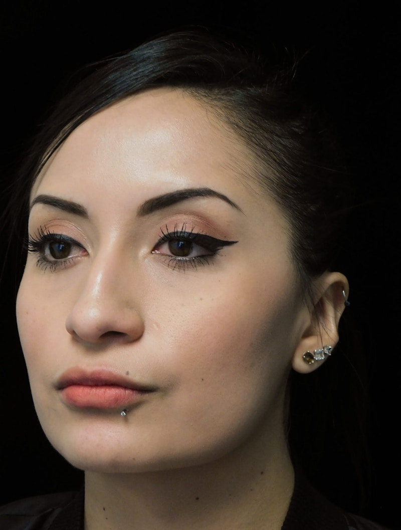 Beverly Hills Oblique View Rhinoplasty Before in Beverly Hills by Dr. Deepak Raj Dugar | Patient 292548 Dr. Deepak Raj Dugar