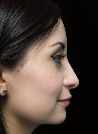 Beverly Hills Right Side View Rhinoplasty After in Beverly Hills by Dr. Deepak Raj Dugar | Patient 292548 Dr. Deepak Raj Dugar