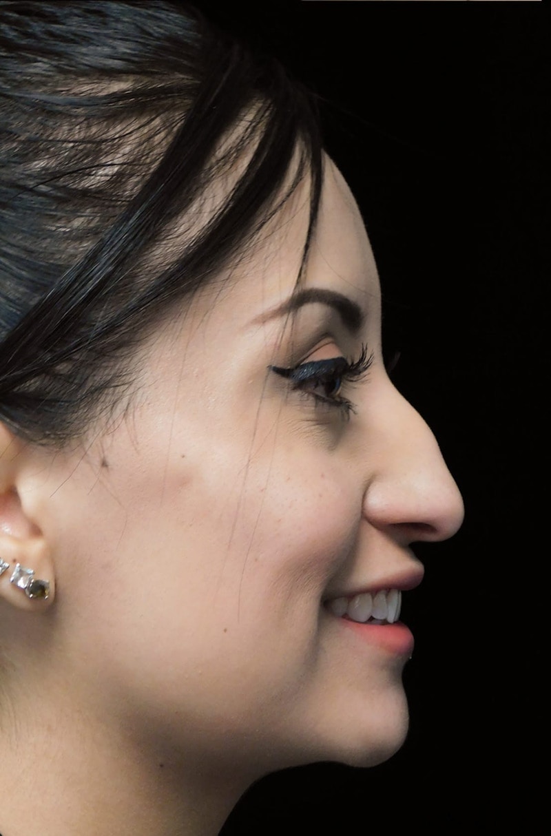 Beverly Hills Right Side View Rhinoplasty Before in Beverly Hills by Dr. Deepak Raj Dugar | Patient 292548 Dr. Deepak Raj Dugar