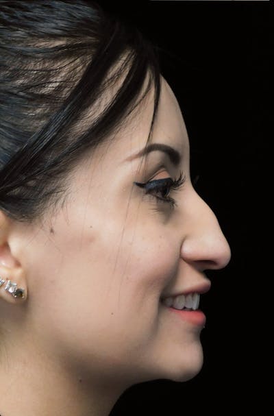 Beverly Hills Right Side View Rhinoplasty Before in Beverly Hills by Dr. Deepak Raj Dugar | Patient 292548 Dr. Deepak Raj Dugar