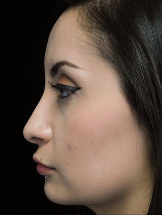 Beverly Hills Left Side View Rhinoplasty After in Beverly Hills by Dr. Deepak Raj Dugar | Patient 292548 Dr. Deepak Raj Dugar