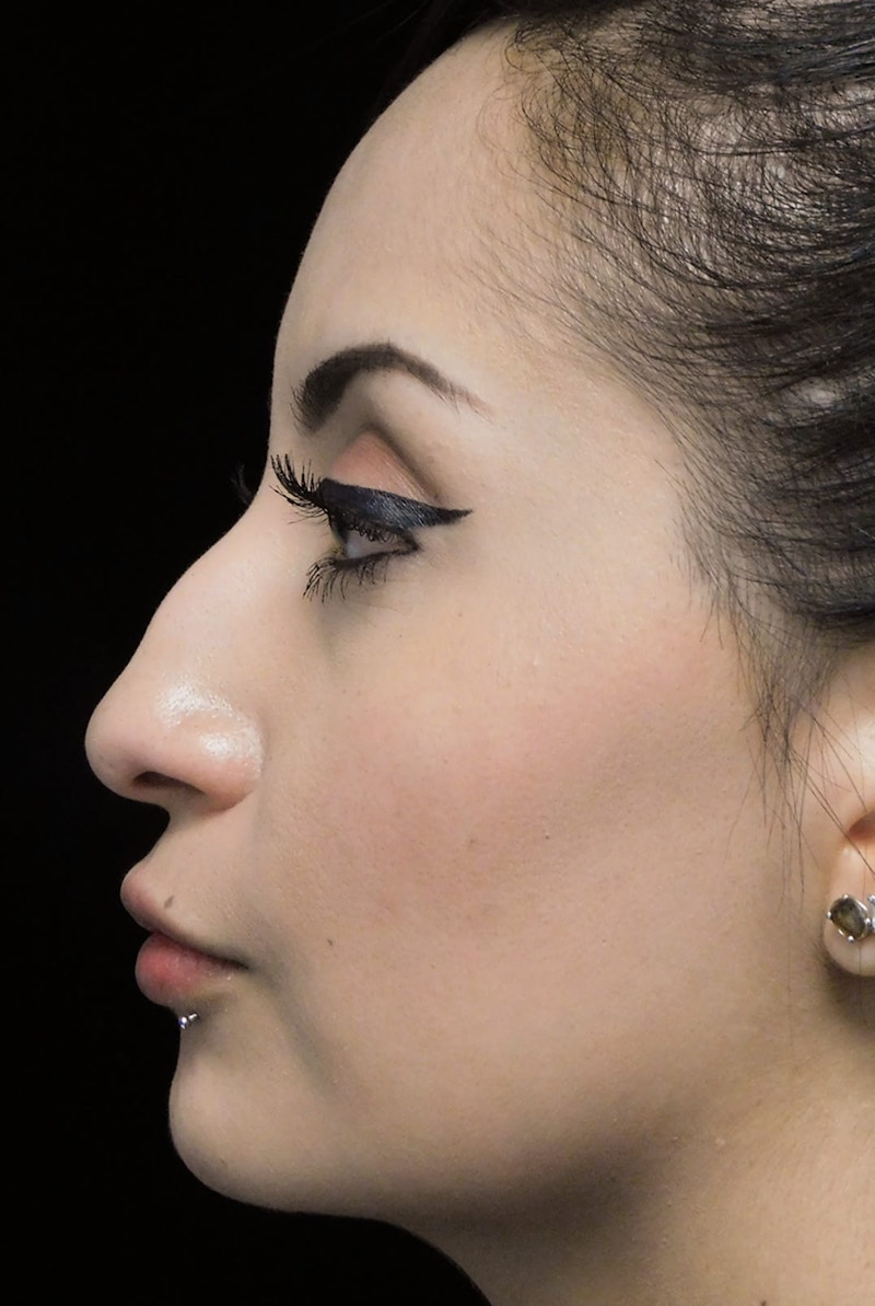 Beverly Hills Left Side View Rhinoplasty Before in Beverly Hills by Dr. Deepak Raj Dugar | Patient 292548 Dr. Deepak Raj Dugar