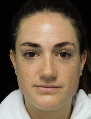 Beverly Hills Rhinoplasty Before & After Gallery - Patient 251280 - Image 4 Dr. Deepak Raj Dugar