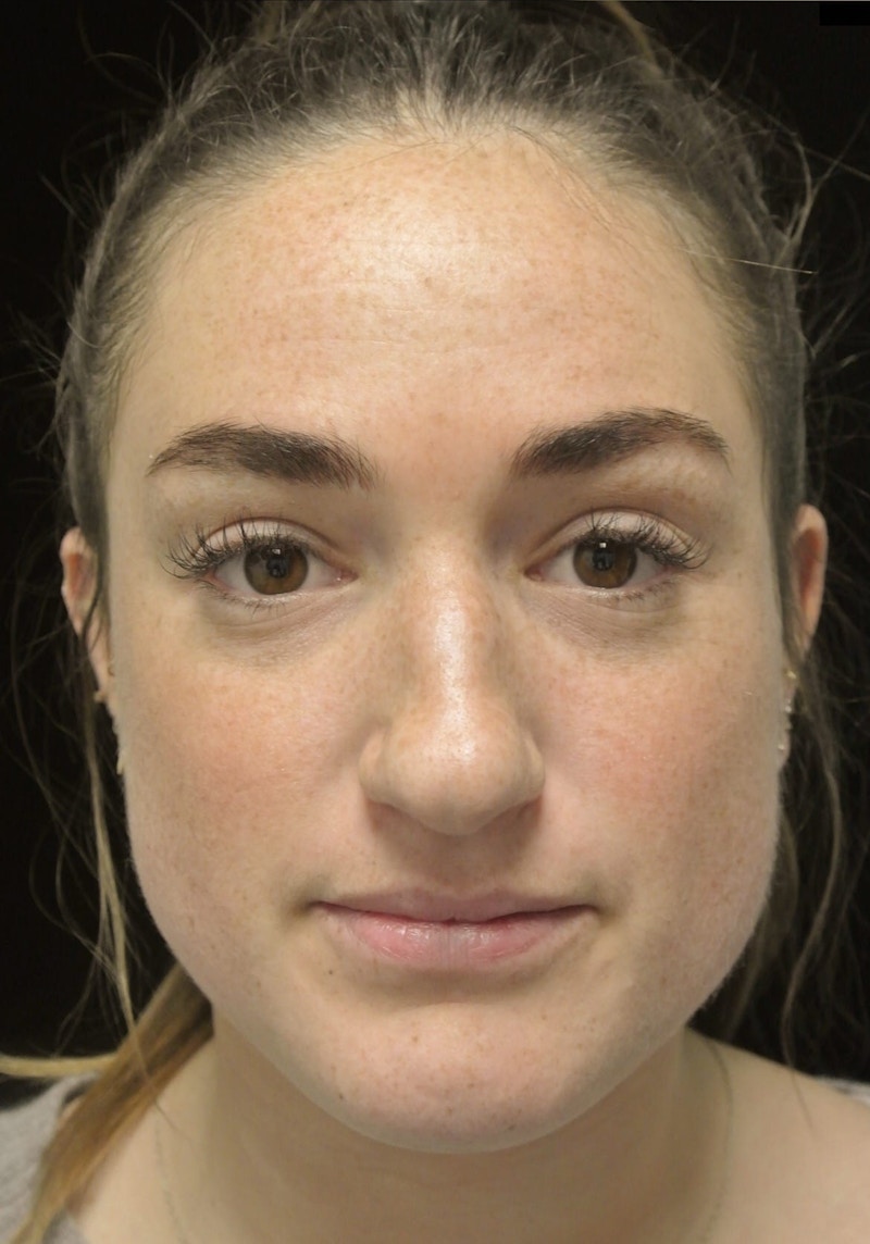 Beverly Hills Rhinoplasty Before & After Gallery - Patient 251280 - Image 3 Dr. Deepak Raj Dugar