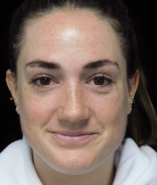 Beverly Hills Rhinoplasty Before & After Gallery - Patient 251280 - Image 6 Dr. Deepak Raj Dugar