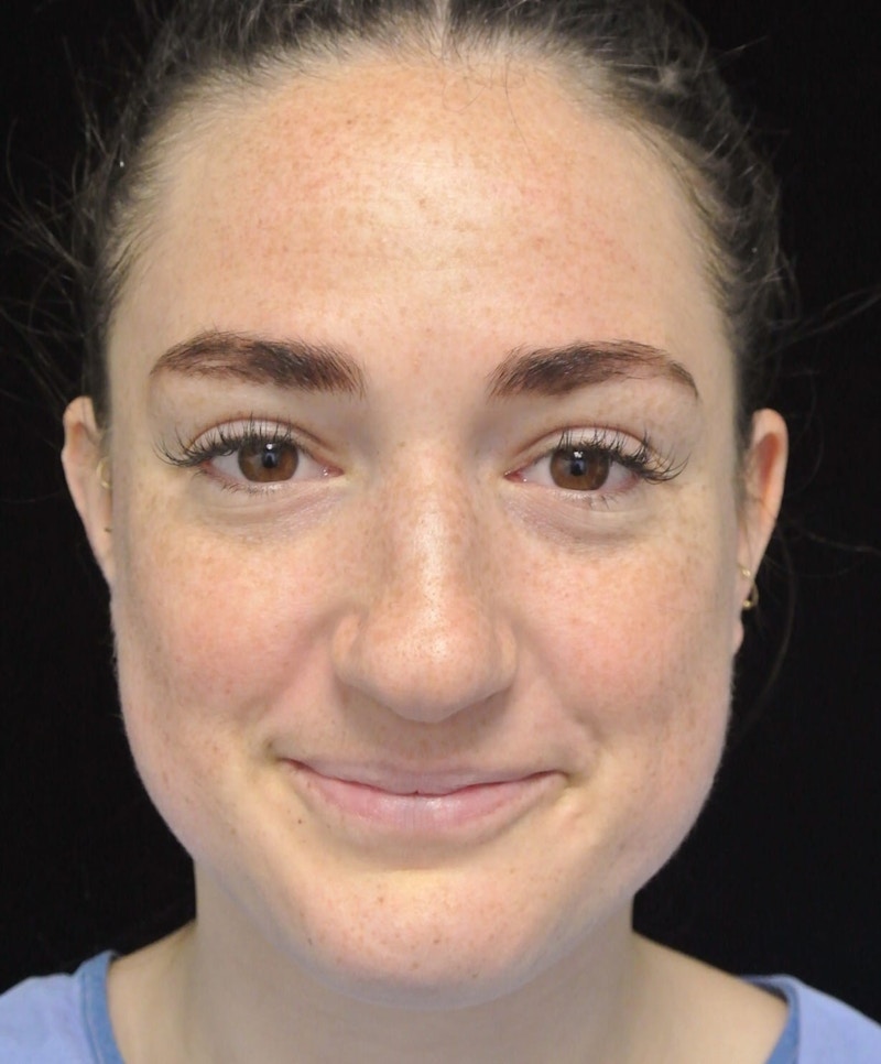 Beverly Hills Rhinoplasty Before & After Gallery - Patient 251280 - Image 5 Dr. Deepak Raj Dugar