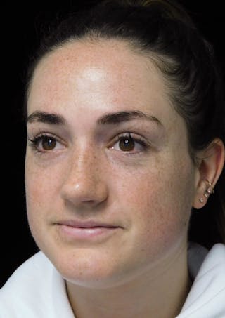 Beverly Hills Rhinoplasty Before & After Gallery - Patient 251280 - Image 8 Dr. Deepak Raj Dugar