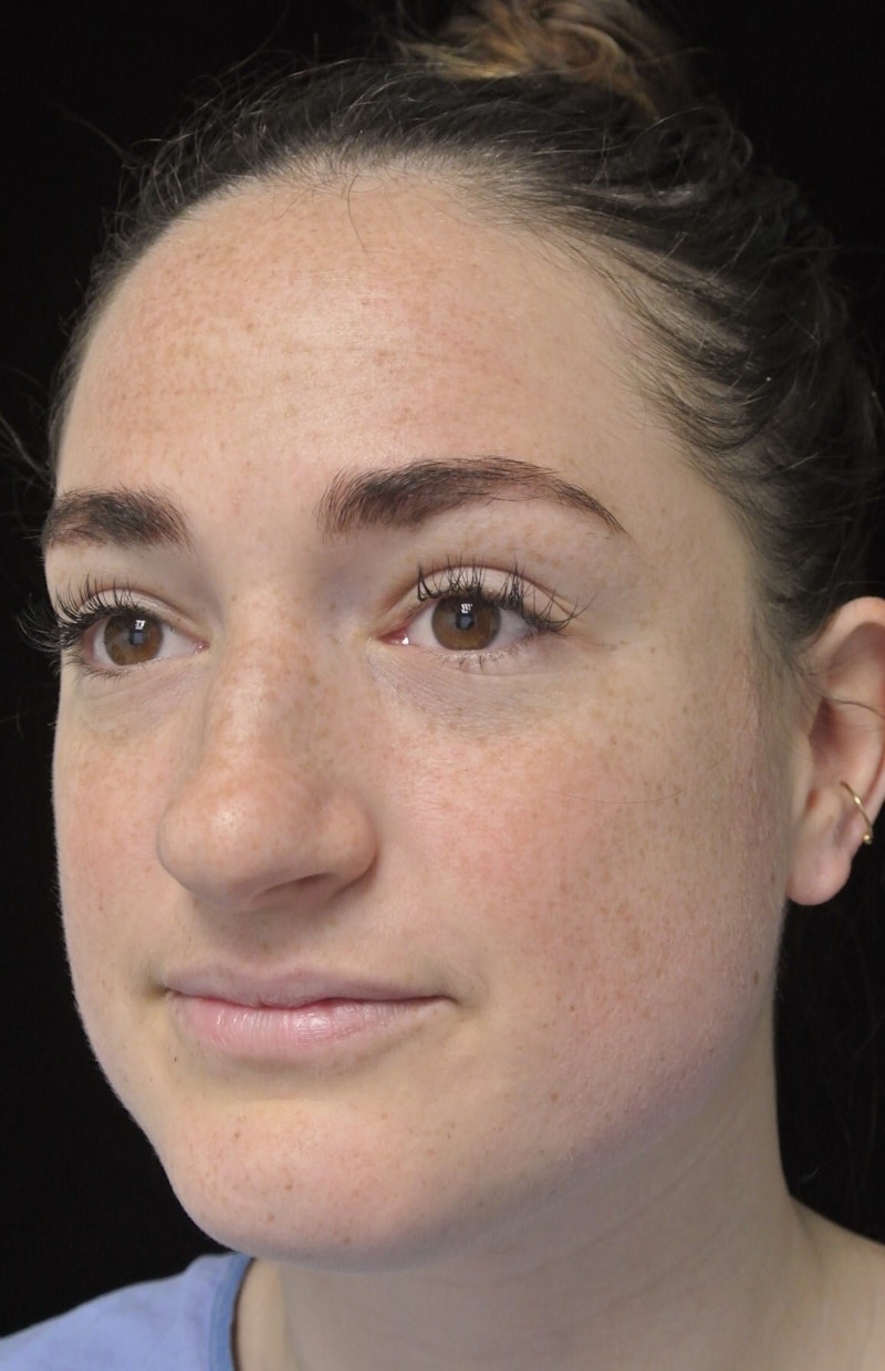 Beverly Hills Rhinoplasty Before & After Gallery - Patient 251280 - Image 7 Dr. Deepak Raj Dugar