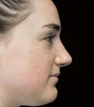 Beverly Hills Rhinoplasty Before & After Gallery - Patient 251280 - Image 2 Dr. Deepak Raj Dugar