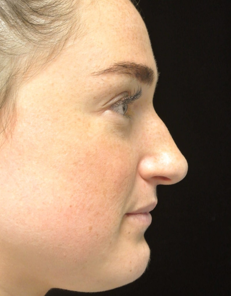 Beverly Hills Rhinoplasty Before & After Gallery - Patient 251280 - Image 1 Dr. Deepak Raj Dugar