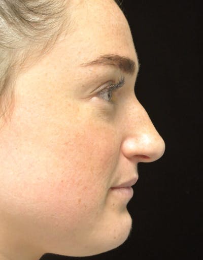 Beverly Hills Rhinoplasty Before & After Gallery - Patient 251280 - Image 1 Dr. Deepak Raj Dugar