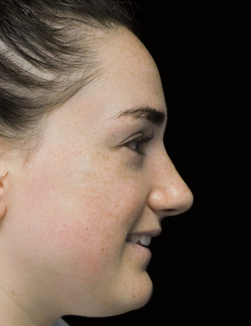 Beverly Hills Rhinoplasty Before & After Gallery - Patient 251280 - Image 10 Dr. Deepak Raj Dugar