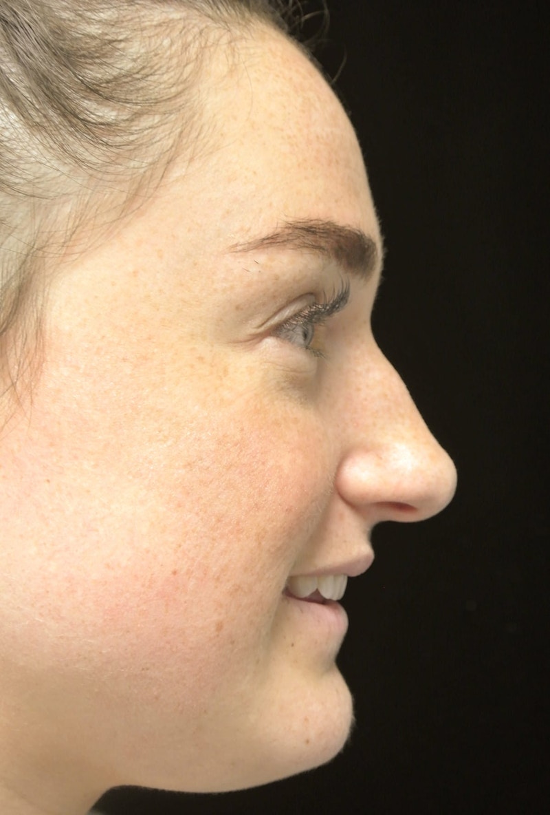 Beverly Hills Rhinoplasty Before & After Gallery - Patient 251280 - Image 9 Dr. Deepak Raj Dugar