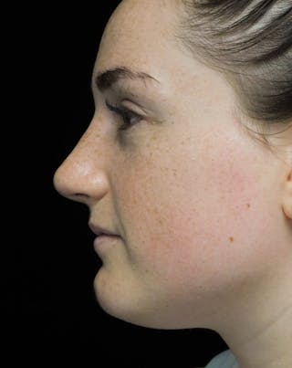 Beverly Hills Rhinoplasty Before & After Gallery - Patient 251280 - Image 12 Dr. Deepak Raj Dugar