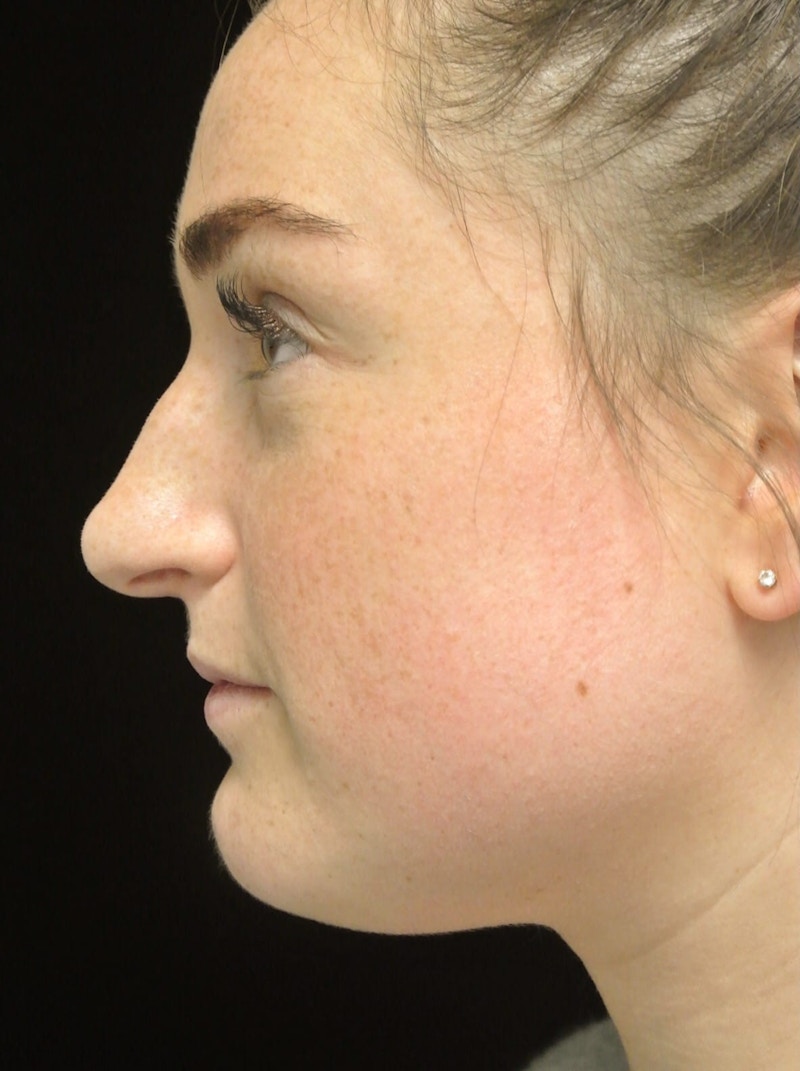Beverly Hills Rhinoplasty Before & After Gallery - Patient 251280 - Image 11 Dr. Deepak Raj Dugar