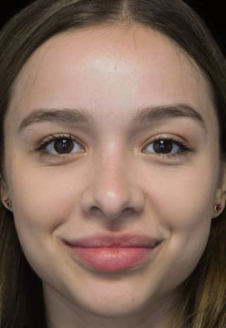 Beverly Hills Rhinoplasty Before & After Gallery - Patient 377700 - Image 4 Dr. Deepak Raj Dugar