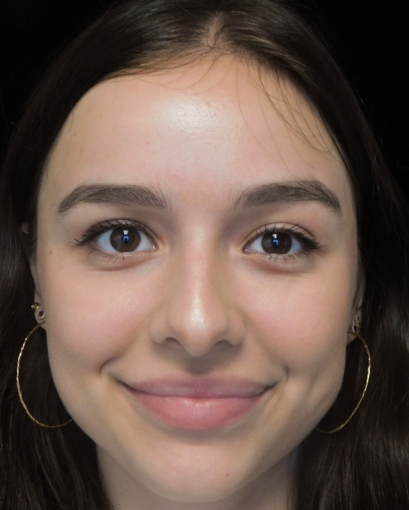 Beverly Hills Rhinoplasty Before & After Gallery - Patient 377700 - Image 3 Dr. Deepak Raj Dugar