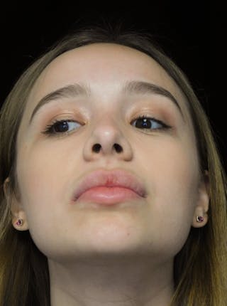 Beverly Hills Rhinoplasty Before & After Gallery - Patient 377700 - Image 6 Dr. Deepak Raj Dugar