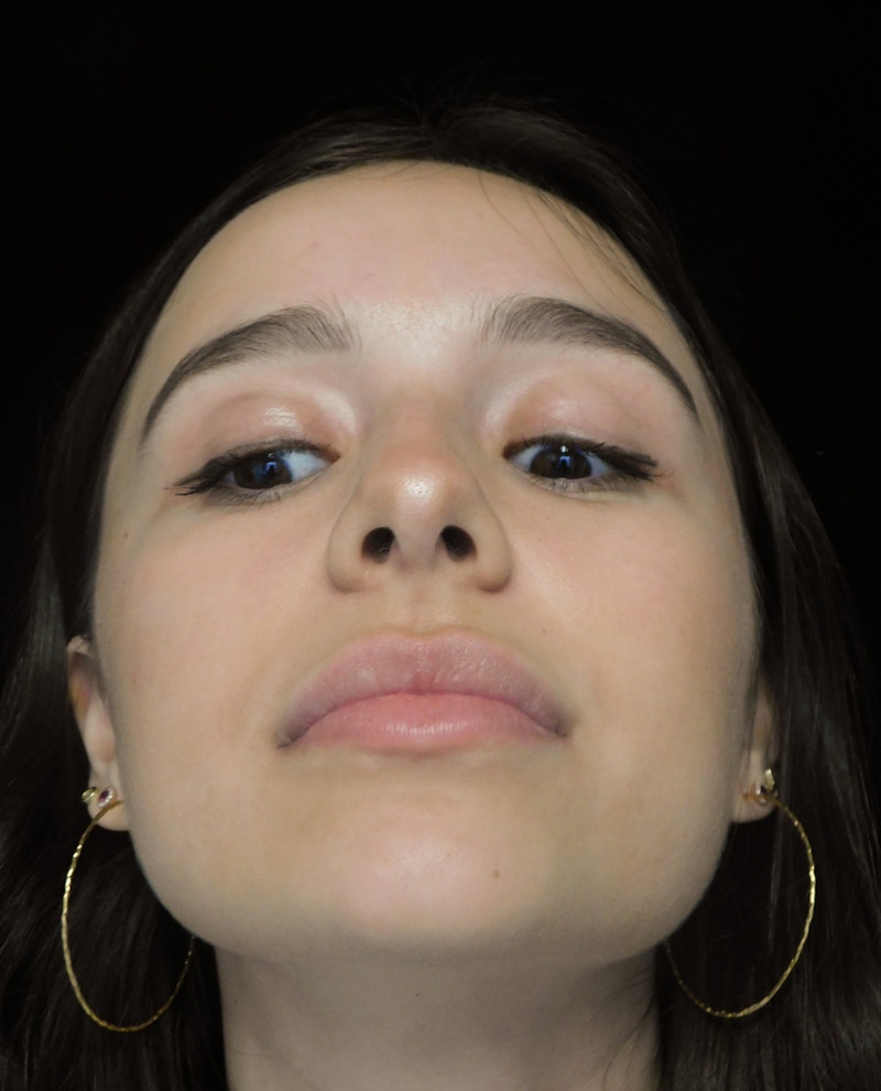 Beverly Hills Rhinoplasty Before & After Gallery - Patient 377700 - Image 5 Dr. Deepak Raj Dugar