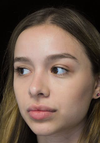 Beverly Hills Rhinoplasty Before & After Gallery - Patient 377700 - Image 8 Dr. Deepak Raj Dugar