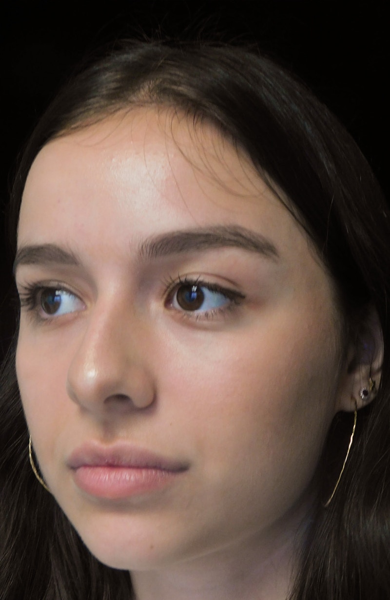 Beverly Hills Rhinoplasty Before & After Gallery - Patient 377700 - Image 7 Dr. Deepak Raj Dugar