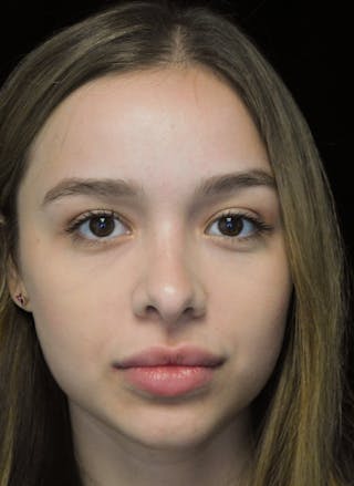 Beverly Hills Rhinoplasty Before & After Gallery - Patient 377700 - Image 10 Dr. Deepak Raj Dugar