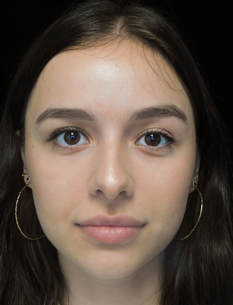 Beverly Hills Rhinoplasty Before & After Gallery - Patient 377700 - Image 9 Dr. Deepak Raj Dugar