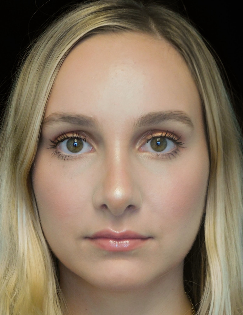 Beverly Hills Rhinoplasty Before & After Gallery - Patient 955593 - Image 4 Dr. Deepak Raj Dugar