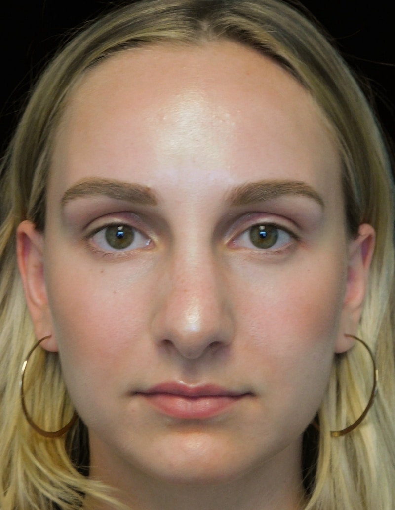 Beverly Hills Rhinoplasty Before & After Gallery - Patient 955593 - Image 3 Dr. Deepak Raj Dugar