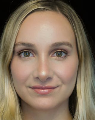 Beverly Hills Rhinoplasty Before & After Gallery - Patient 955593 - Image 6 Dr. Deepak Raj Dugar